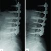 A Novel Unidirectional Porous ß-tricalcium Phosphate Grafting Impregnated with Bone Marrow Blood Collected from Unfractured Vertebral Bodies for Non-union of Osteoporotic Vertebral Fracture: A Preliminary Case Report