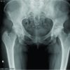 Idiopathic Transient Osteoporosis during Pregnancy – Report of a Clinical Case