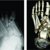 Limb Salvage for a Mangled Foot: A Case Report