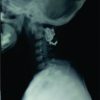 Preschool Child with Displaced Odontoid Synchondrosis Fracture Treated by Surgical Management Showing Excellent Remodeling