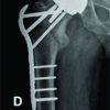 Internal Fixation of an Intertrochanteric Fracture after Resurfacing Arthroplasty: A Case Report