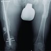 Bone Crushing in Infected Pseudarthrosis – An Extraordinary Way to Treat Osteomyelitis Caused by Resistant Bacteria