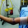 Arm Board Technique for Closed Reduction Percutaneous Pinning of Displaced Supracondylar Fractures of Humerus in Children: Technical Note
