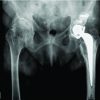 Technical Considerations of Complex Primary Total Hip Arthroplasty in a Rare Case of Combined Achondroplasia and Hereditary Multiple Exostosis Syndromes