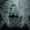 The False Security of Pelvic Binders: 2 Cases of Missed Injuries due to Anatomical Reduction