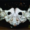 Apophysitis of the Ischial Tuberosity: A Case Report
