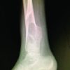Segmental Fibulectomy to Excise the Adherent Distal Tibia Osteochondroma in a Case of Hereditary Multiple Exostosis – A Rare Case Report