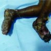 Pig Bite Injury Mimicking as Battered Baby Syndrome Leading to Bilateral Foot Amputation in a Toddler: A Diagnostic Dilemma and a Rare Case Report