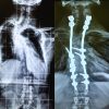 Management of Proximal Thoracic Kyphoscoliosis with Early Myelopathy in a Young Adult with Neurofibromatosis Type 1: A Case Report and Review of Literature