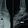 Surgical Management of Concomitant Proximal Tibiofibular Instability and Medial Collateral Ligament Tear: A Case Report