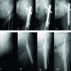 Subcapital Fracture with Avascular Necrosis of the Whole Femoral Head After Fixation of an Intertrochanteric Fracture: A Case Report