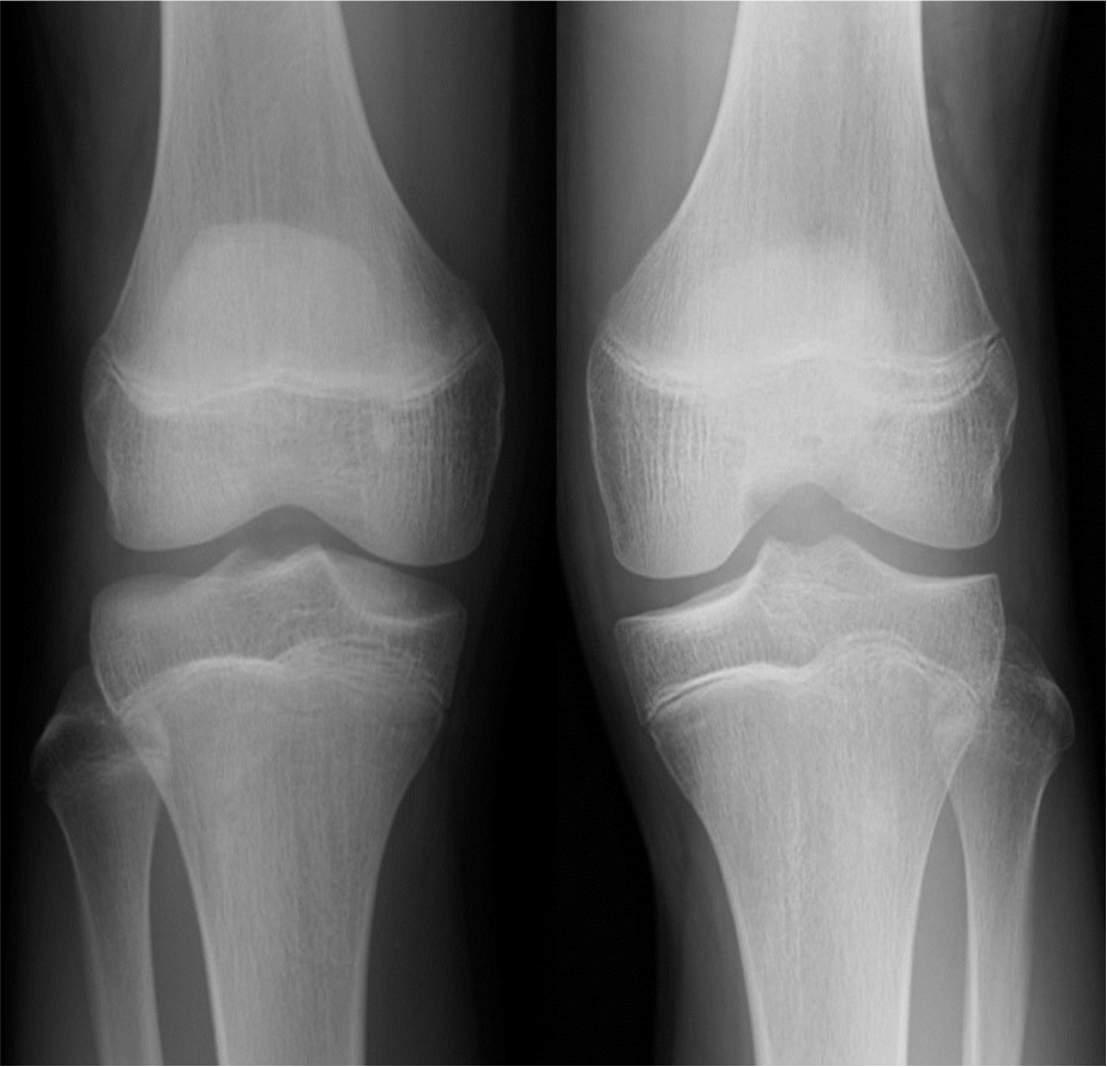 Bipartite Patella in an Elite Football Player – A Rare Cause of ...