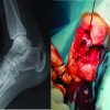 Partial Heel Pad Avulsion with Open Calcaneal Tuberosity Fracture with Tendo-achilles Rupture – A Case Report
