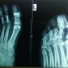 Open Interphalangeal Dislocation of the Great Toe in an Amateur Football Player: A Rare Case Report