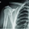 Glenohumeral Migration of Intraosseous Suture- Button after Acromioclavicular JointACJ Reconstruction – A Case Report