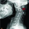 Management of Neglected Odontoid Fracture in the Ankylosed Spine: A Case Report and Technical Note