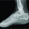 Tuberculosis of Calcaneus – A Case Report and Review of Literature
