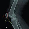 Reconstruction of Neglected Patellar Tendon Rupture using Tendoachilles’ Allograft with Transosseous Tunnels: A Case Report