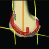 Intentional Femoral Component Flexion – A Method to Balance the Flexion-extension Gap in Navigated Total Knee Replacement