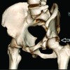 Novel Technique for Femoral Head Reconstruction using Allograft following Obturator Hip Dislocation