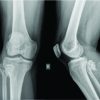 Secondary Chondrosarcoma Arising from the Proximal Fibula Presenting as Sciatica