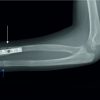 Multiple Unilateral Upper Limb Fractures in the Pediatric Setting – A Case Report