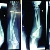 Bilateral Monteggia Fracture: A Rare Case Presentation