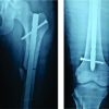 Ipsilateral Posterior Hip Dislocation and Femur Shaft Fracture – A Rare Presentation