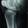 Closed Reduction of an Irreducible Knee Dislocation: A Case Report