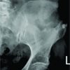Incisional Hernia Secondary to Iliac Crest Bone Graft: A Rare Case Report and Review of Literature