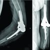 Total Elbow Arthroplasty in an Older Patient with a Forearm Amputation: A Case Report in a Spastic Elbow