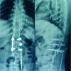 Migration of Rod: A Case Report of Rare Complication of Minimal Invasive Surgery in Spinal Trauma with Narrative Review of Literature