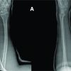 Non-operative Management of an Adult Both Bone Forearm Fractures – A Case Report and Literature Review