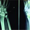 Isolated Intra-articular Displaced Distal Ulna Injury: A Rare Case Report and Review of Literature