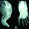 Single-Stage Correction of Severe Rigid Ankle Equinus Deformity by Talectomy and Tibiocalcaneal Fusion in Adulthood: A Case Report