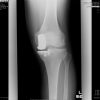 Arthroscopic Scar Resection for the Treatment of Anteromedial Knee Pain after Oxford Unicompartmental Knee Arthroplasty: A Case Report