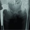 Isolated Septic Arthritis of the Hip Due to Fusobacterium Nucleatum in An Immunocompetent Adult:  A Case Report and Review of the Literature