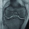 Ipsilateral Medial and Lateral Discoid Meniscus with Medial Meniscus Tear