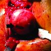 Treatment of the Bullet, Traversing Femoral Neck, Lodged in Hip Joint: Initial Arthroscopic Removal and Subsequent Cartilage Repair