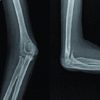 Treatment of Stiff Elbow in Young Patients with Interpositional Arthroplasty for Mobility: Case Series