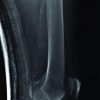 Long Term Bisphosphonate Therapy Induced Periprosthetic Femoral Stress Fracture in a Sliding Hip Screw Implant- A unique case report