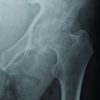 A Case Report of an “Incidental” Neck of Femur Fracture