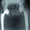 Total Hip Arthroplasty Indicated for a Tuberculous Coxitis Complicating a Controlled Acquired Imunodefficiency Syndrom Condition: A Preliminary Report Concerning a Case