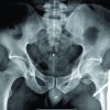Posterior Hip Dislocation with Ipsilateral Femoral Head and Shaft Fracture – Using a Temporary External Fixator as a Method for Closed Reduction