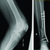 Ipsilateral Hip and Knee Dislocation with Open Tibial Fracture: A Case Report of a Limb Threatening Injury