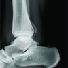 Subperiosteal Hematoma of the Ankle