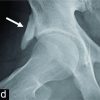 Arthroscopic Resection of a Large Bony Exostosis Arising from the Anterior Inferior Iliac Spine Causing Extra-articular Hip Impingement: A Case Series