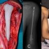 Reconstruction of Proximal Humerus Using Custom Made Acrylic Prosthesis in Malignant Bone Tumors
