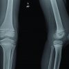 A Sub-acute Septic Arthritis of the Knee; a Sequelae to Thorn Prick Injury of Patella: A Case Report