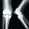 Charcot Fracture in the Calcaneus after Total Knee Arthroplasty: A Case Report